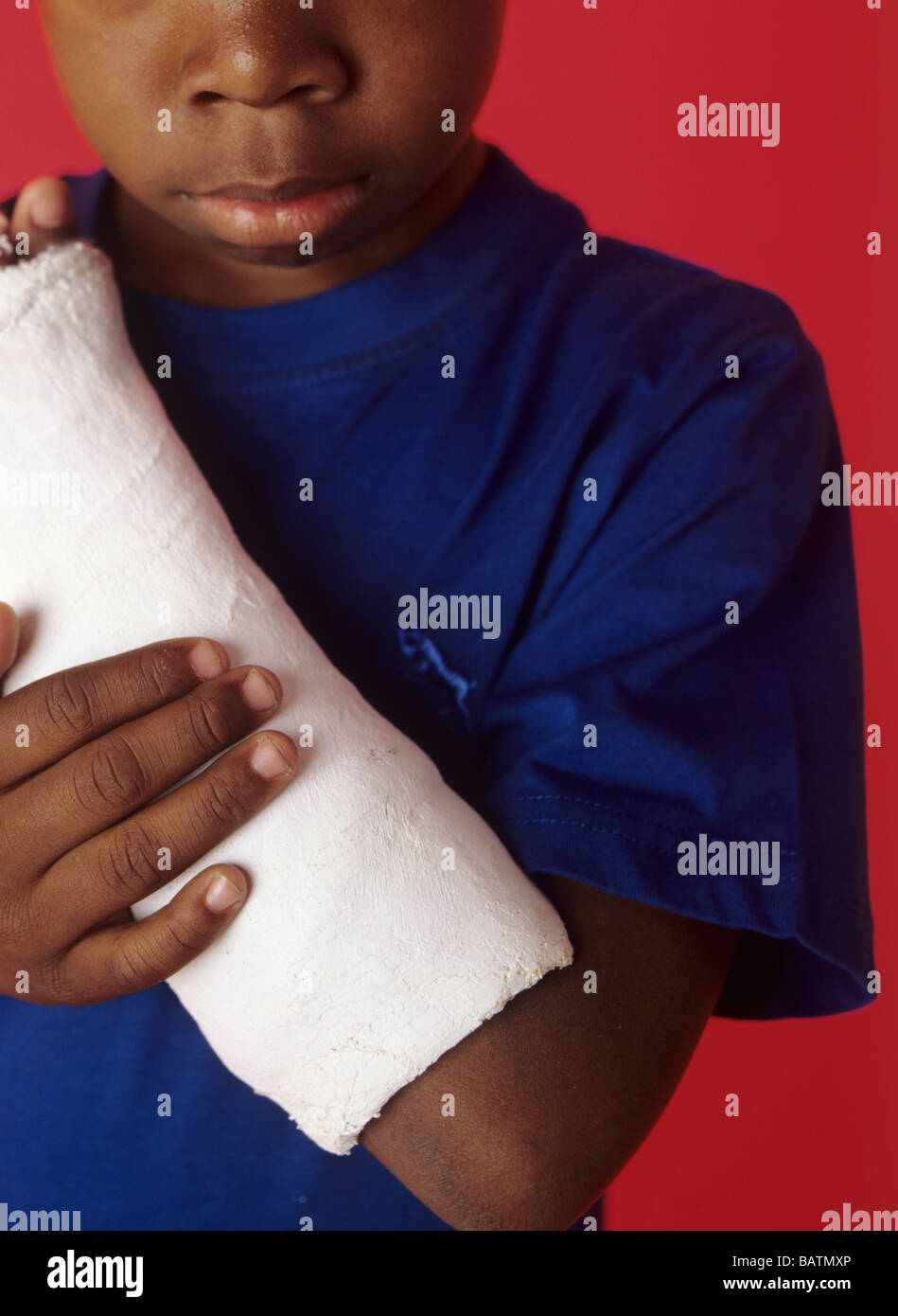 Broken arm. 6year old boy with his broken arm in a plaster cast. The