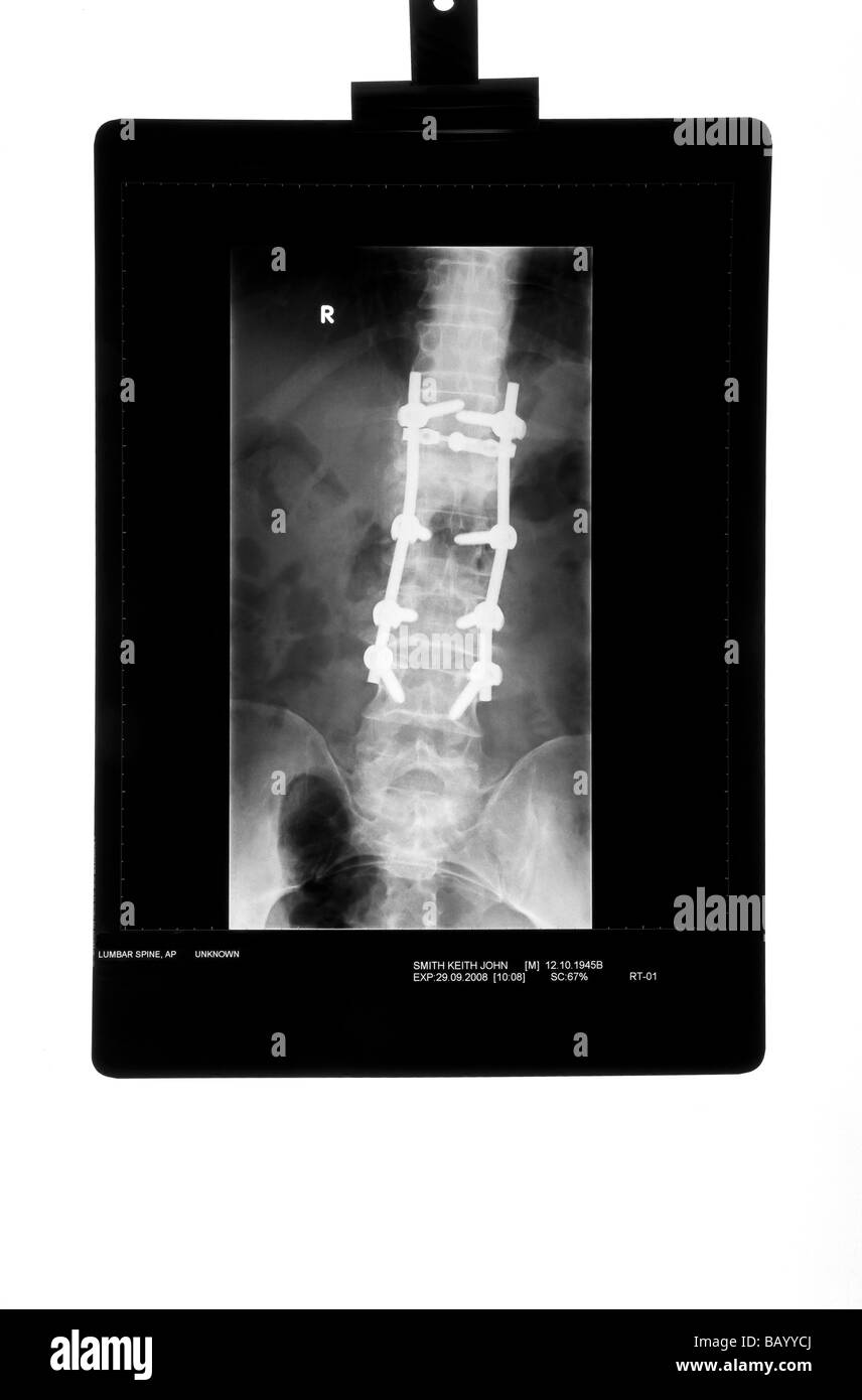 Xray of Male Spine after having a Laminectomy Stock Photo