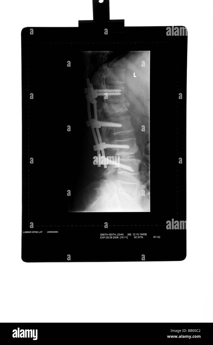 Xray of Male Spine after having a Laminectomy Stock Photo