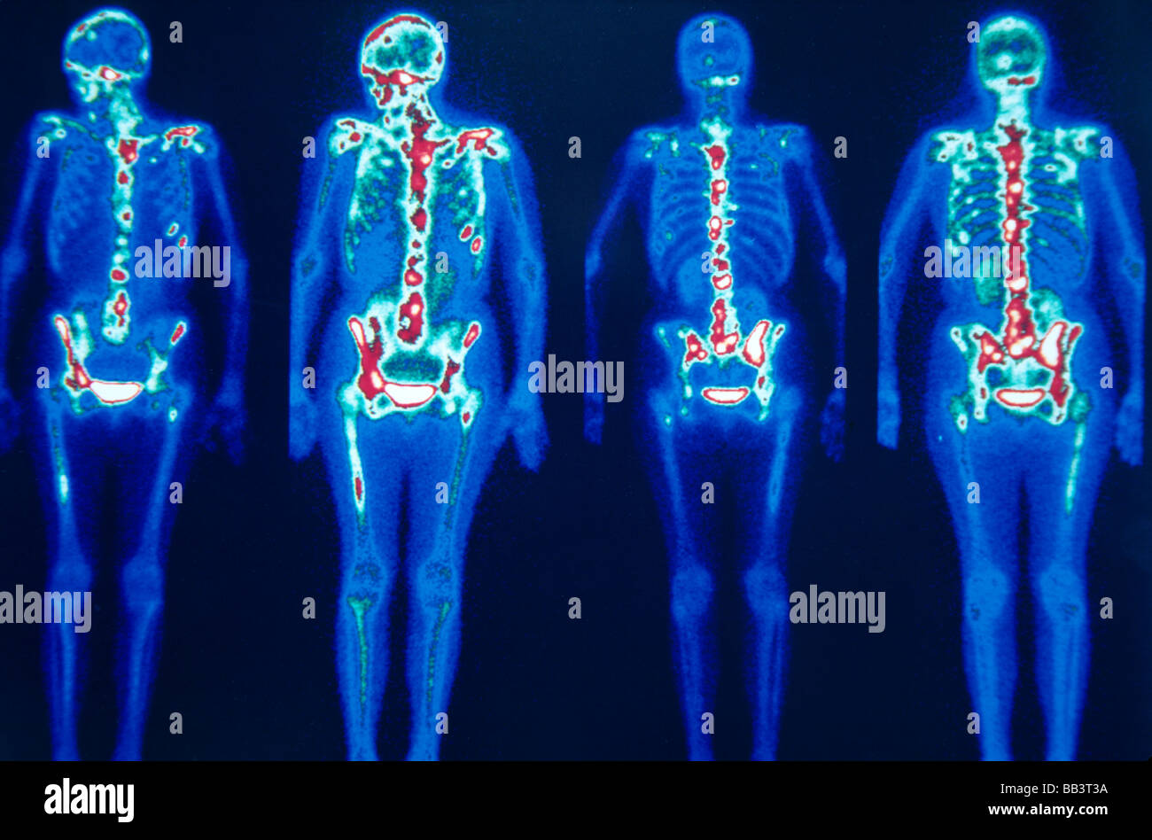 Nuclear medical bone scan, multiple metastatic lesions on lugs Stock Photo