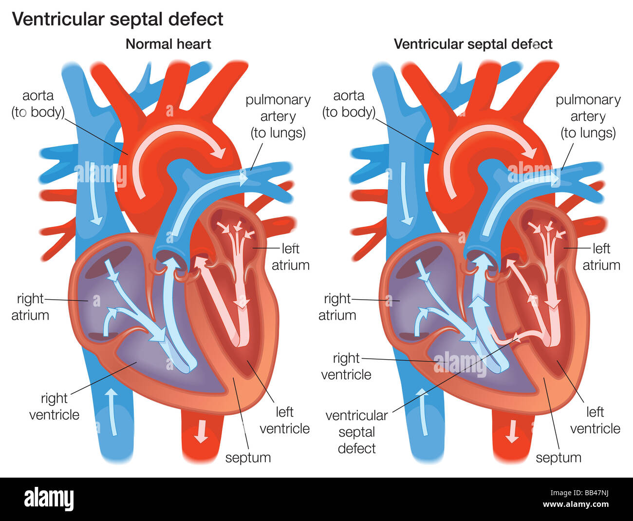 Comparison of a normal heart to one with a ventricular septal defect Stock Photo