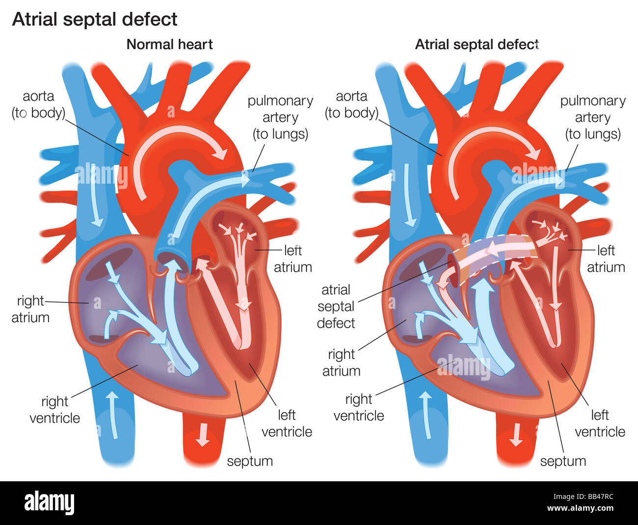 Diagram demonstrating the difference between a normal heart and a heart with an atrial septal defect Stock Photo