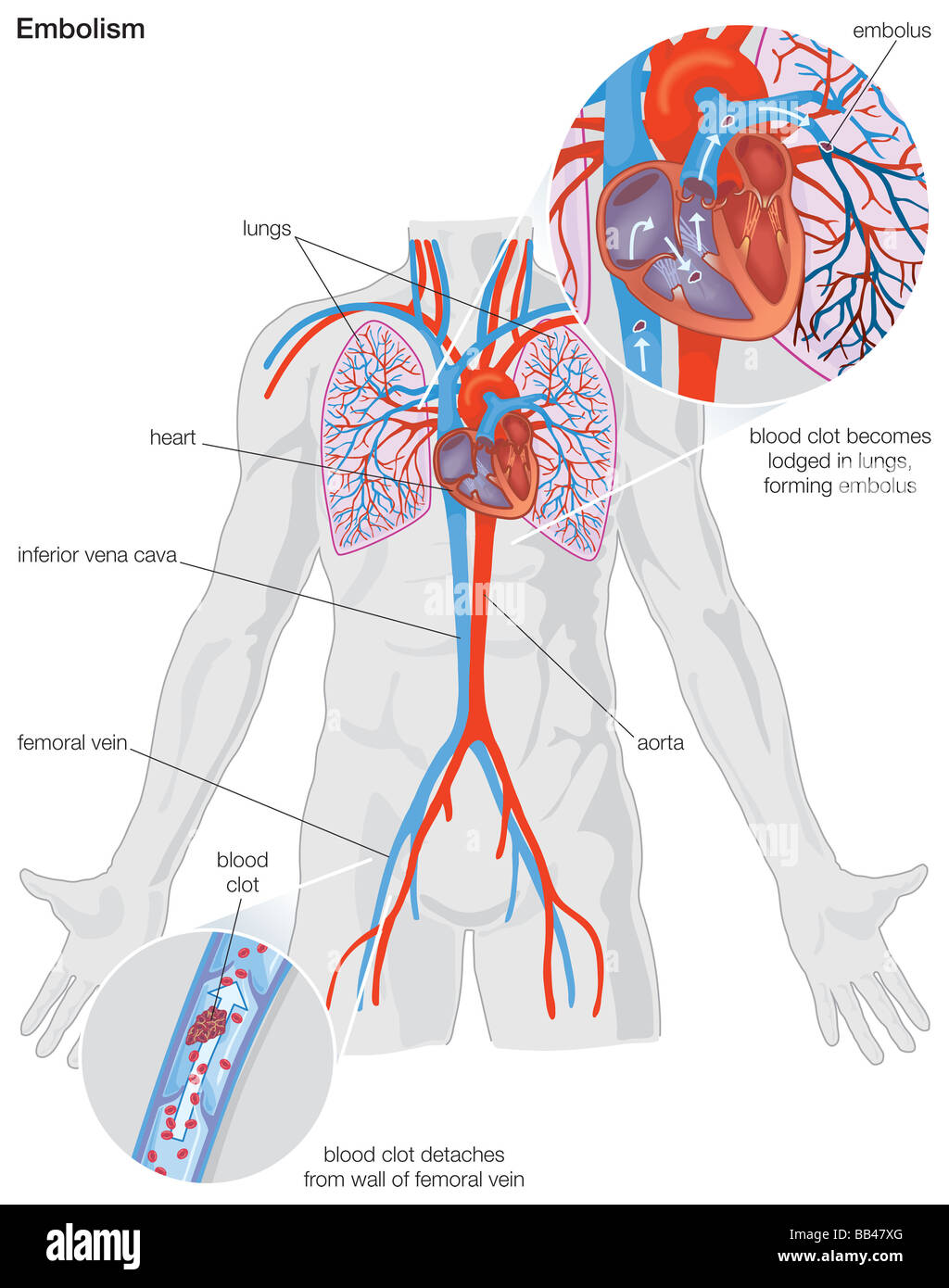 Diagram demonstrating the progression of an arterial embolism Stock Photo