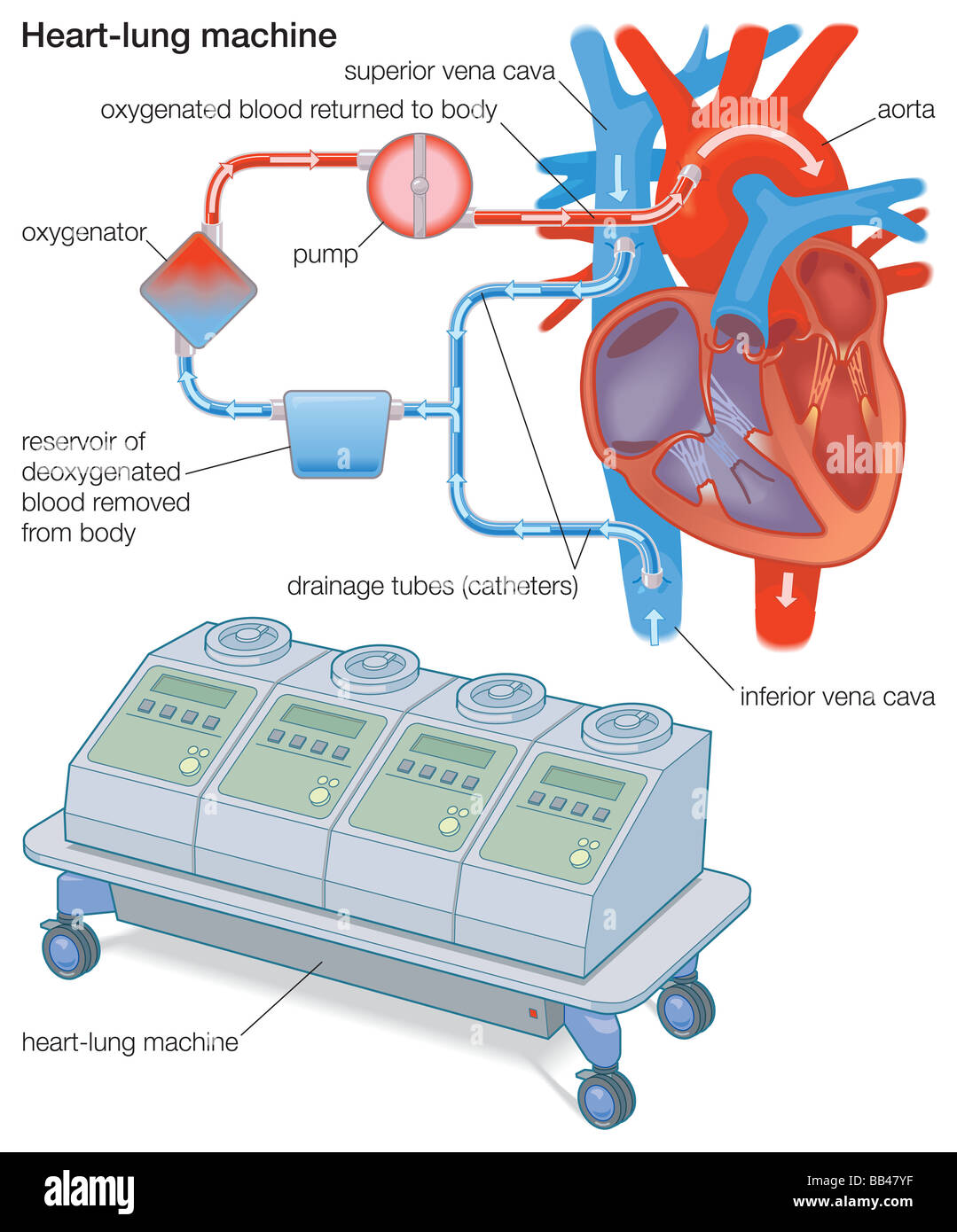 A heart-lung machine diverts blood from the body to an oxygenator, which removes CO2, adds O2, and returns the blood to the body Stock Photo