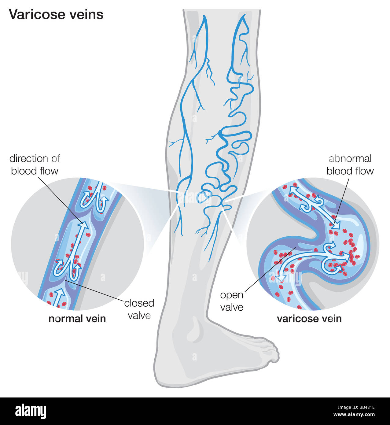 Diagram illustrating varicose veins Stock Photo