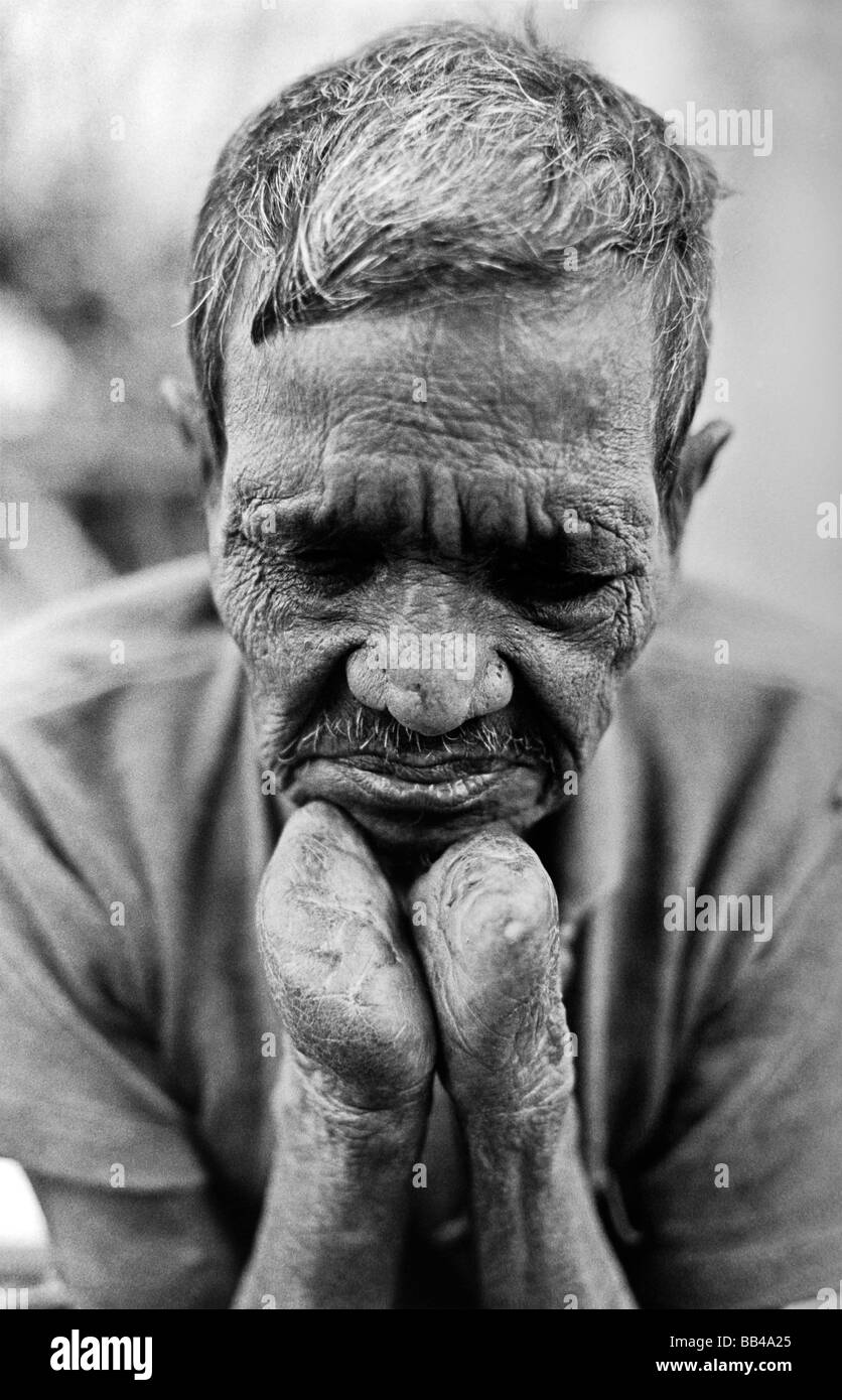 Leprosy patient, resident of the lepers colony in Puri, India. Stock Photo