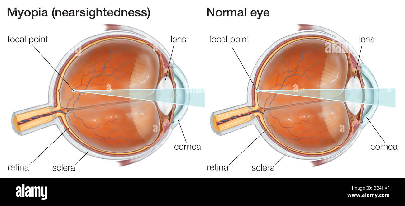 Myopia, or nearsightedness, can be corrected with concave lenses to allow near objects to be brought into focus by the eye. Stock Photo