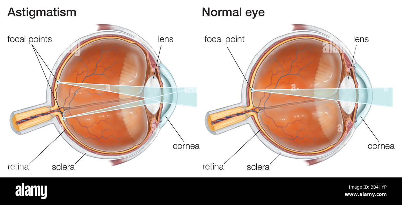 cornea misshapen cornea misshapen