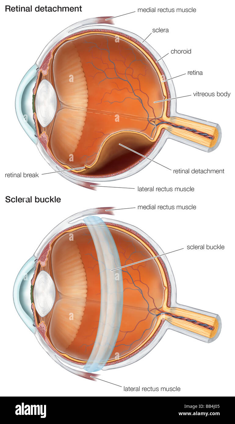 Retinal Repair Radiopaedia Diagram of a retinal detachment hi-res stock photography and images - Alamy