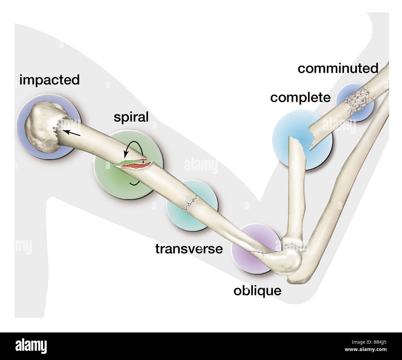 Types of fractures of bones. Stock Photo