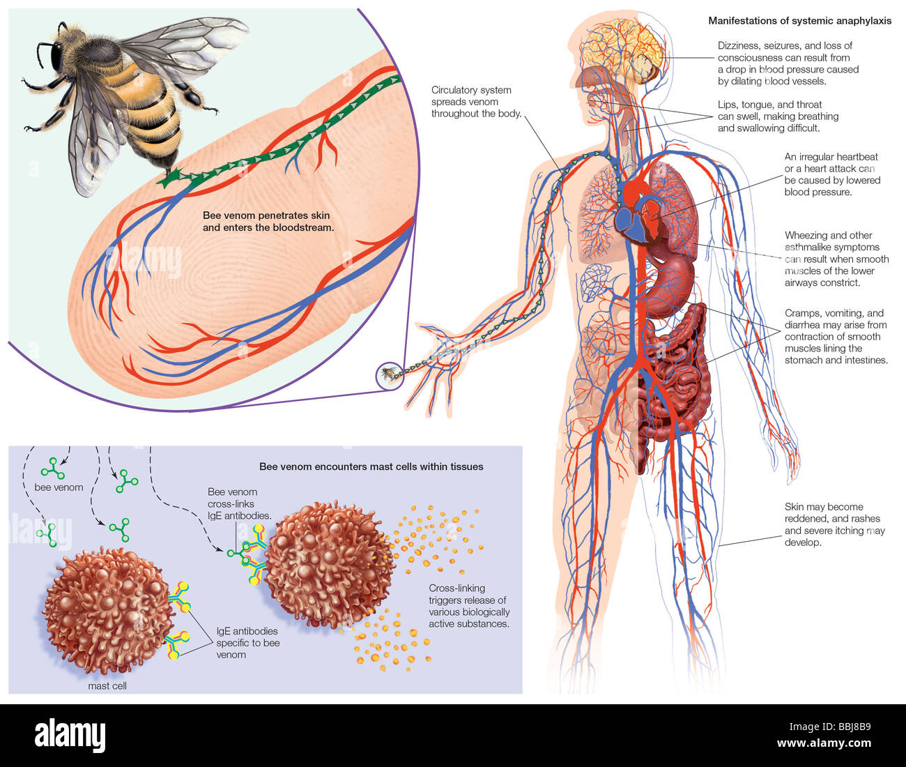 Systemic anaphylactic response to venom from a bee sting in an individual with type I hypersensitivity. Stock Photo