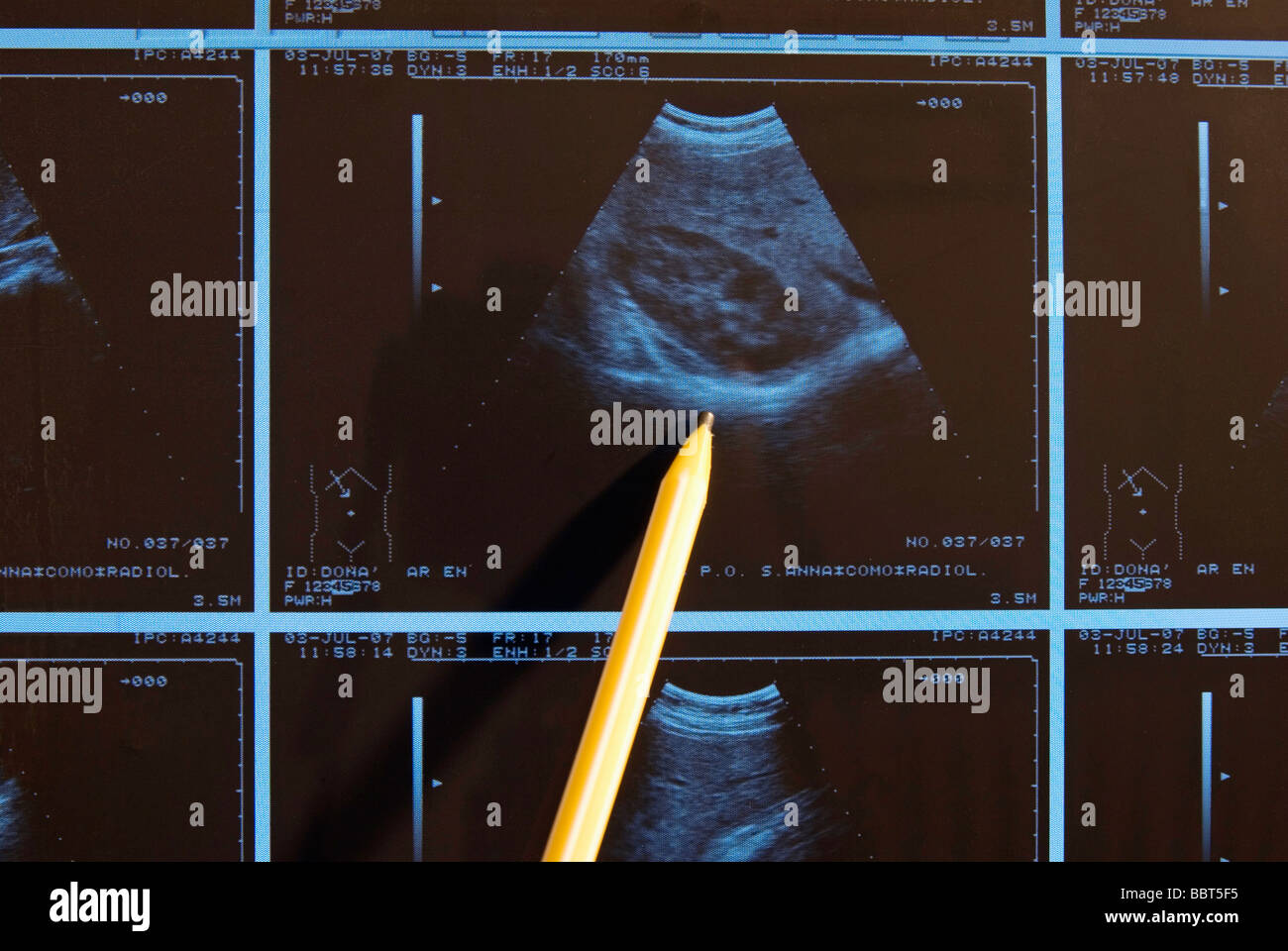 abdominal ecography Stock Photo