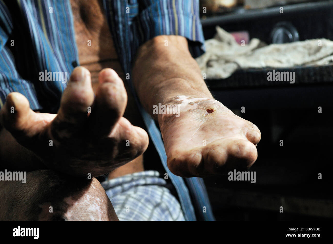 Crippled and injured hands of a leprosy patients, leprosy colony Agua de Dios, Colombia, South America Stock Photo