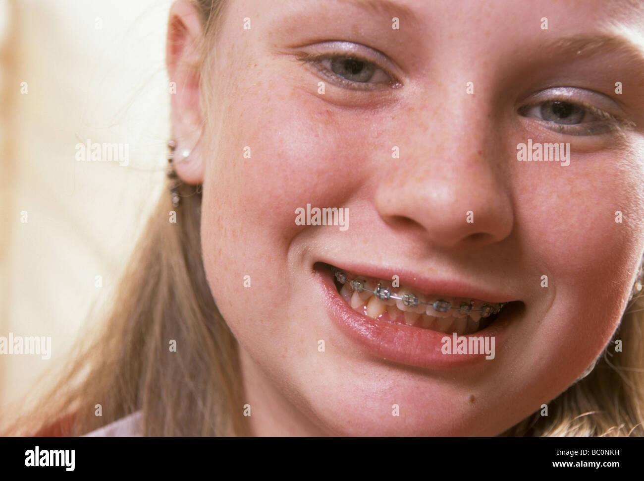 Teem Braces