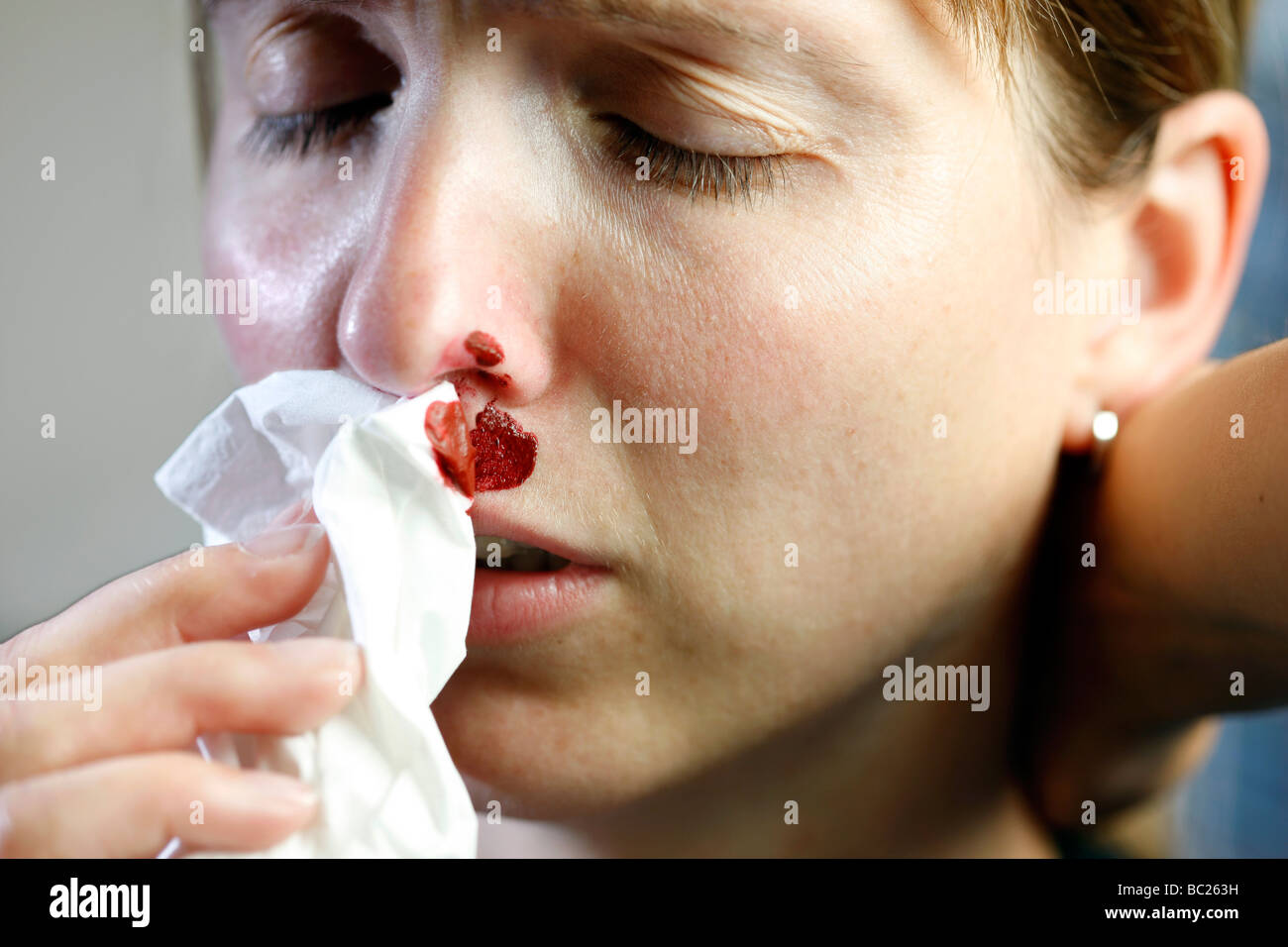 Nose hemorrhage hires stock photography and images Alamy