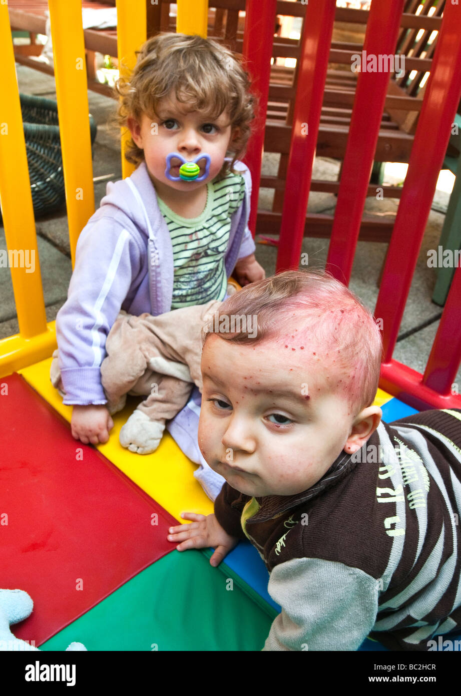 Chicken pox hi-res stock photography and images - Alamy
