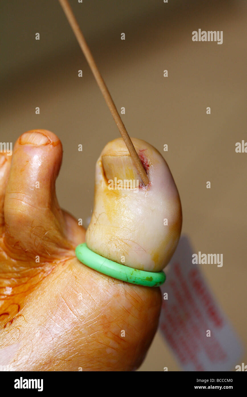 Toenail removal hi-res stock photography and images - Alamy