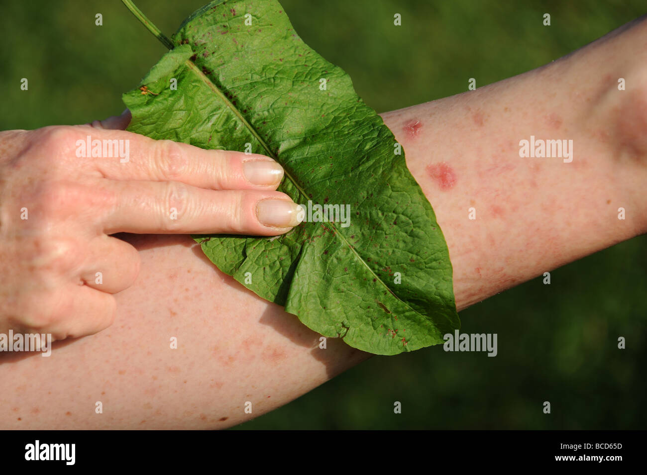 Treating a nettle sting with a Dock Leaf Stock Photo Alamy