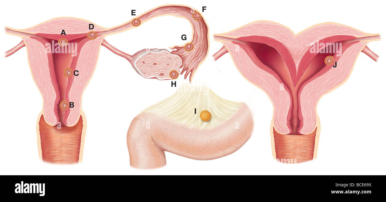 Normal and abnormal sites of implantation of fertilized ovum. Stock Photo