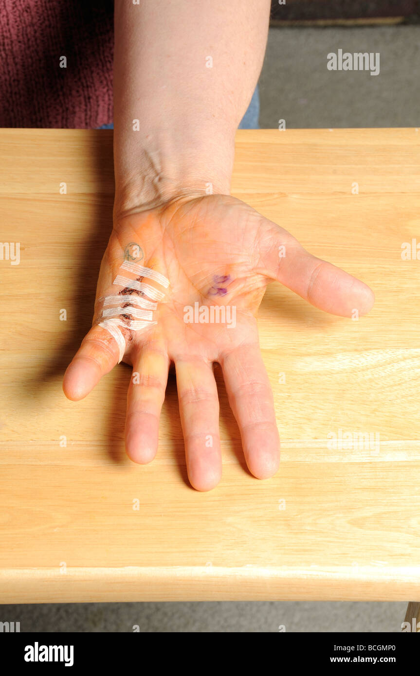 Dupuytren's contracture, after surgery Stock Photo Alamy