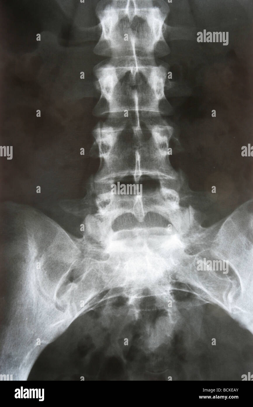 X-RAY film of  lower thorax and pelvis. Stock Photo