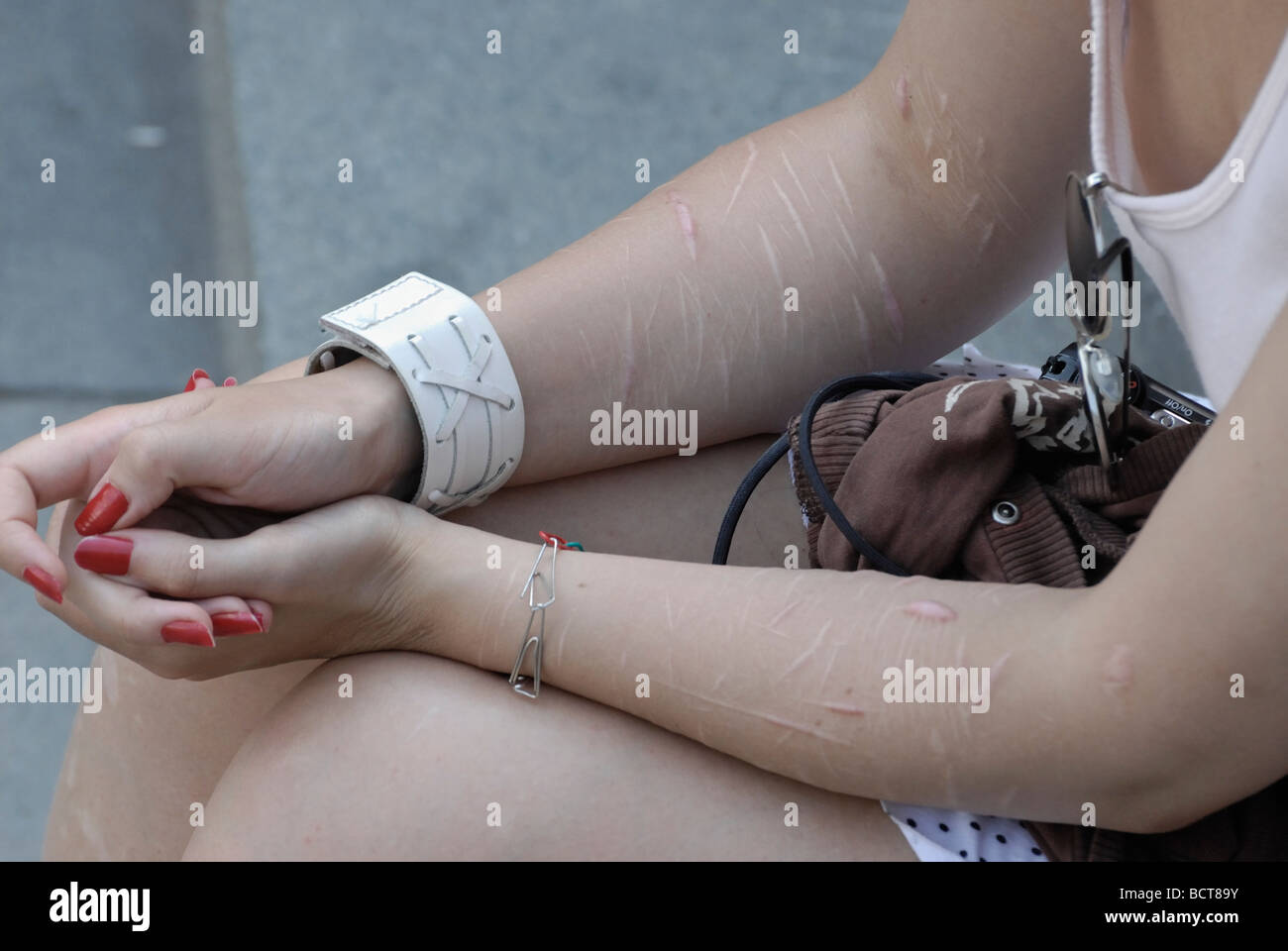 Young girl with many scars on hands Stock Photo