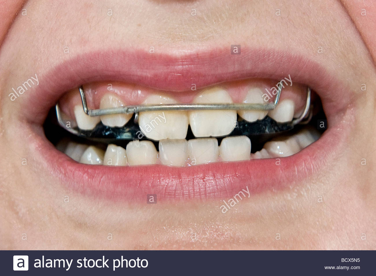 Teeth Brace High Resolution Stock Photography and Images Alamy