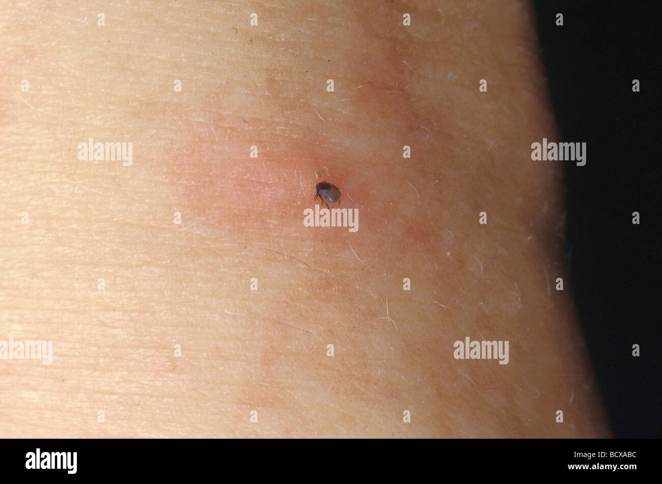 Tick Under Human Skin 528