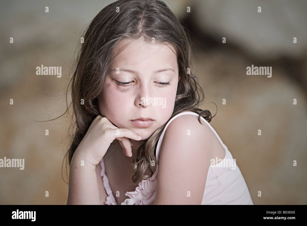 Child abuse bruise hires stock photography and images Alamy