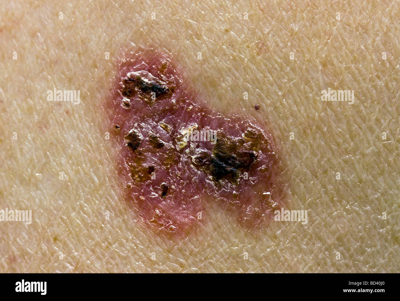 Basal Cell Carcinoma Stock Photo - Alamy
