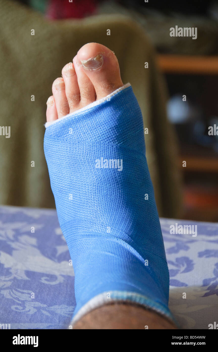 fiberglass cast on a broken ankle Stock Photo