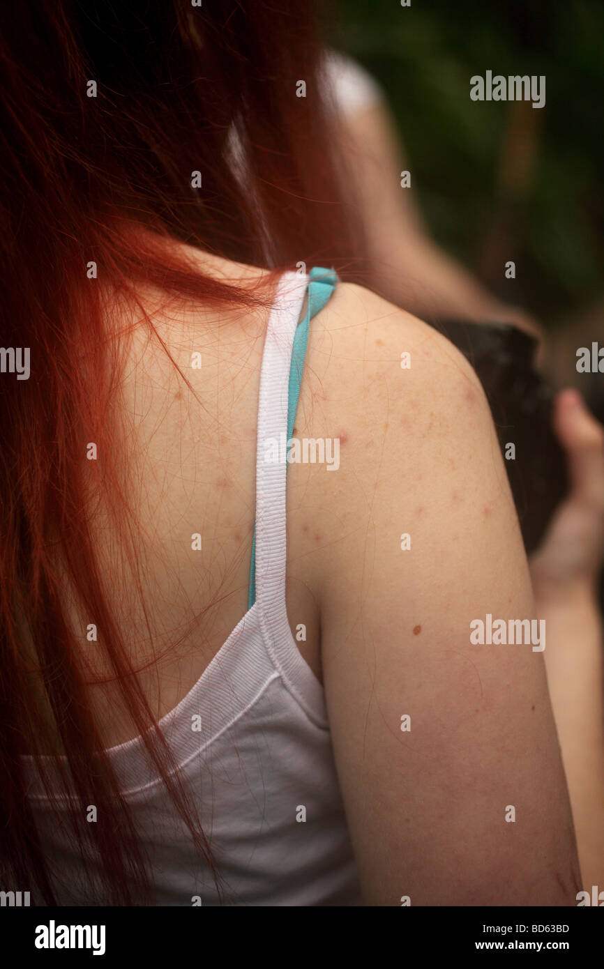 Caucasian teenage girls shoulder acne hires stock photography and