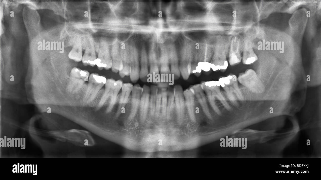 Panoramic Dental X ray Stock Photo Alamy