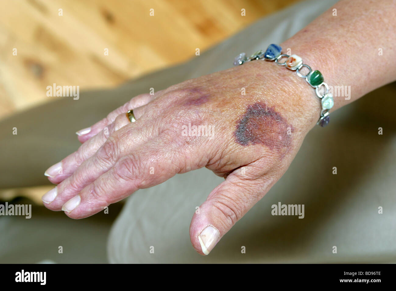 Unexplained bruising