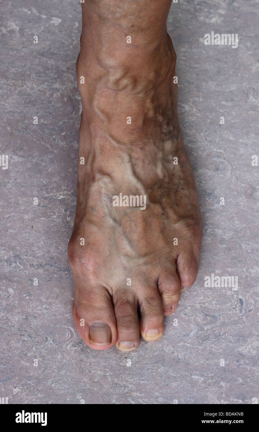 Varicose veins on foot and ankle of adult female Stock Photo