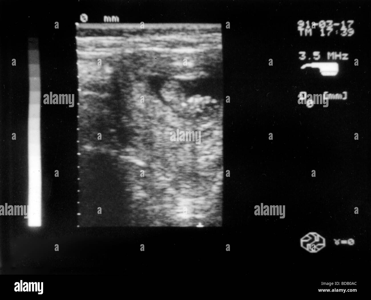 Pregnancy ultrasound Black and White Stock Photos & Images - Alamy