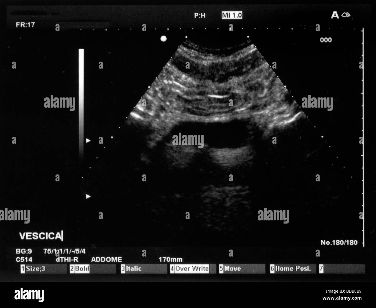 Bladder ultrasound Black and White Stock Photos & Images Alamy