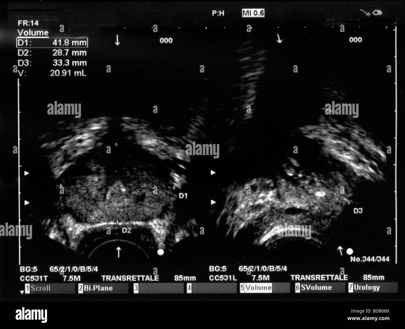 Prostate ultrasound Black and White Stock Photos & Images - Alamy