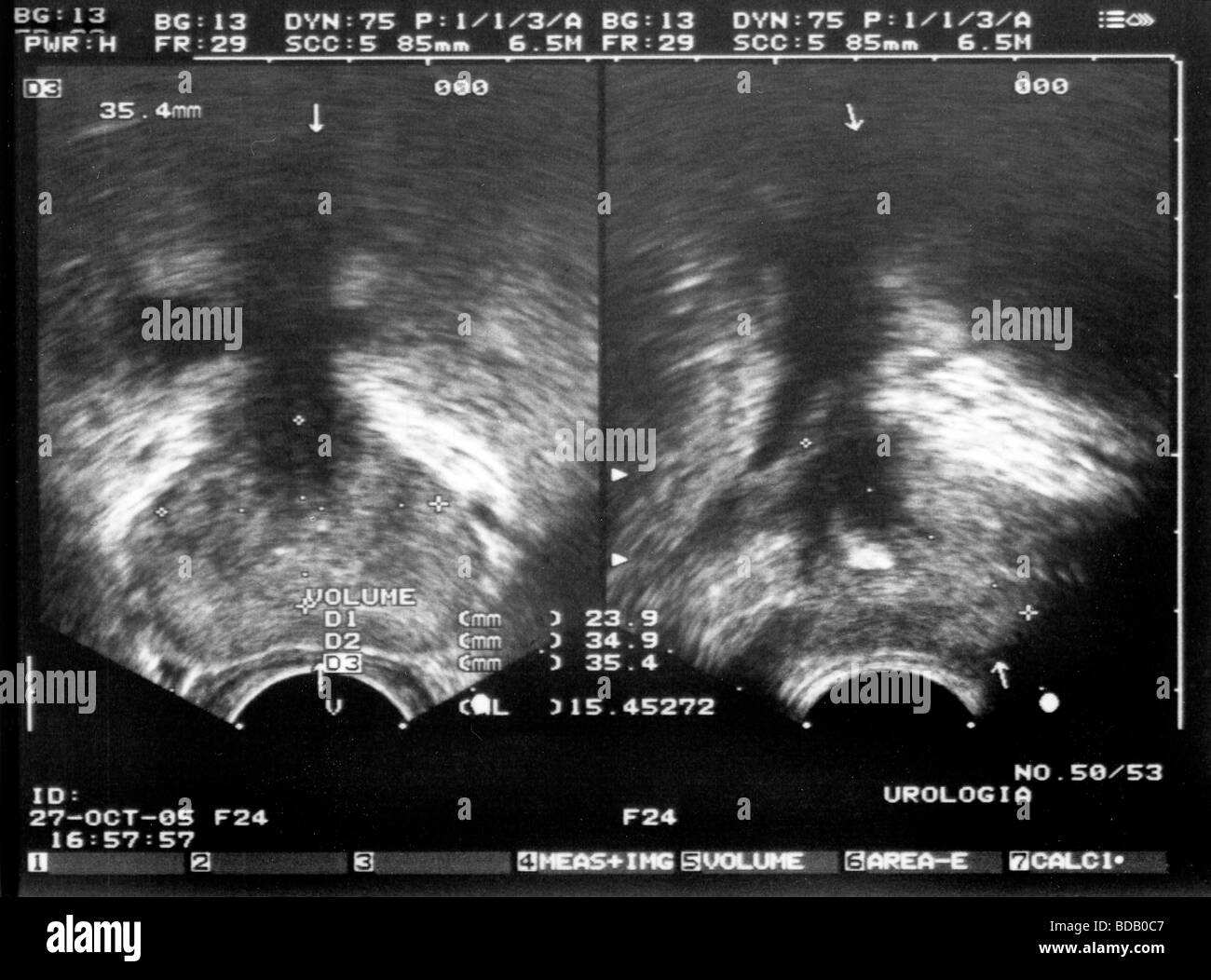 ultrasound prostate Stock Photo