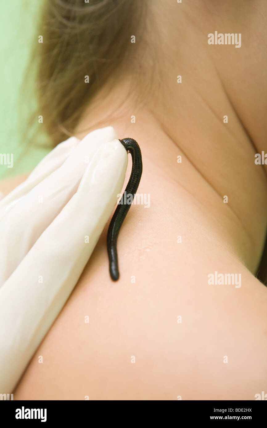 Hirudo therapy. Leech therapy. Hirudinea medicinal. Healer apply leech on the patientś body. Stock Photo