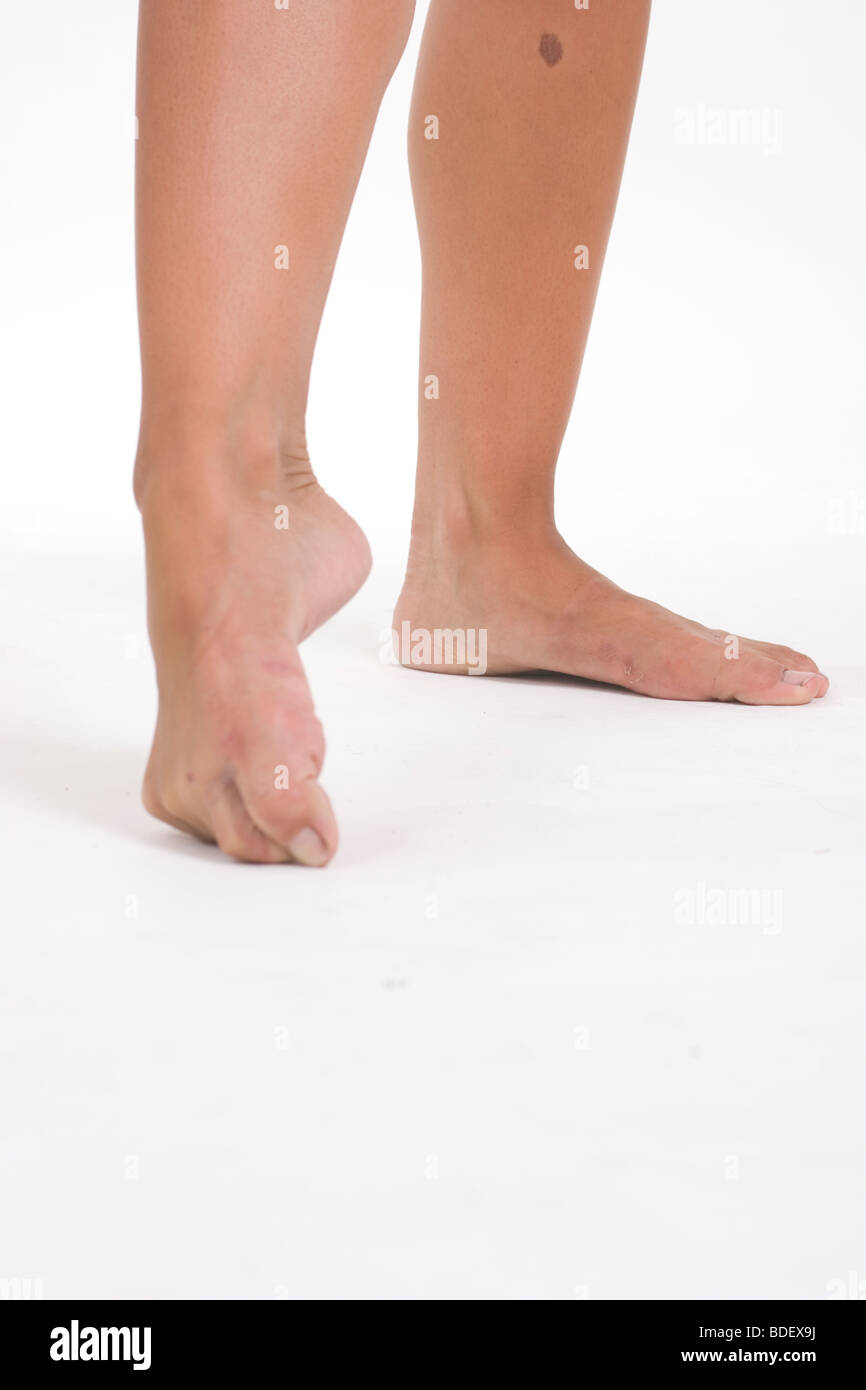 Pair of bruised, barefoot ballerina's feet during practice, doing