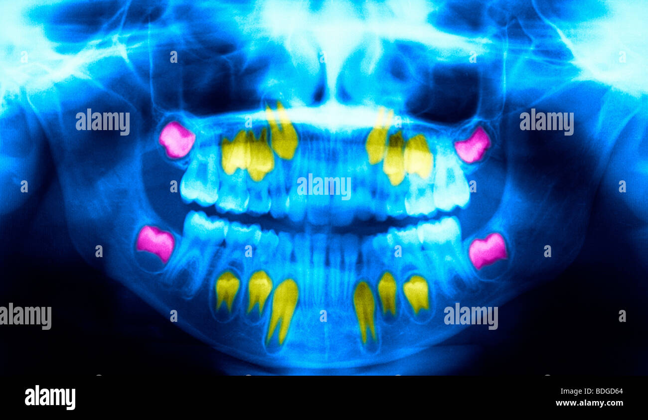 CHILD TOOTH, X-RAY Stock Photo