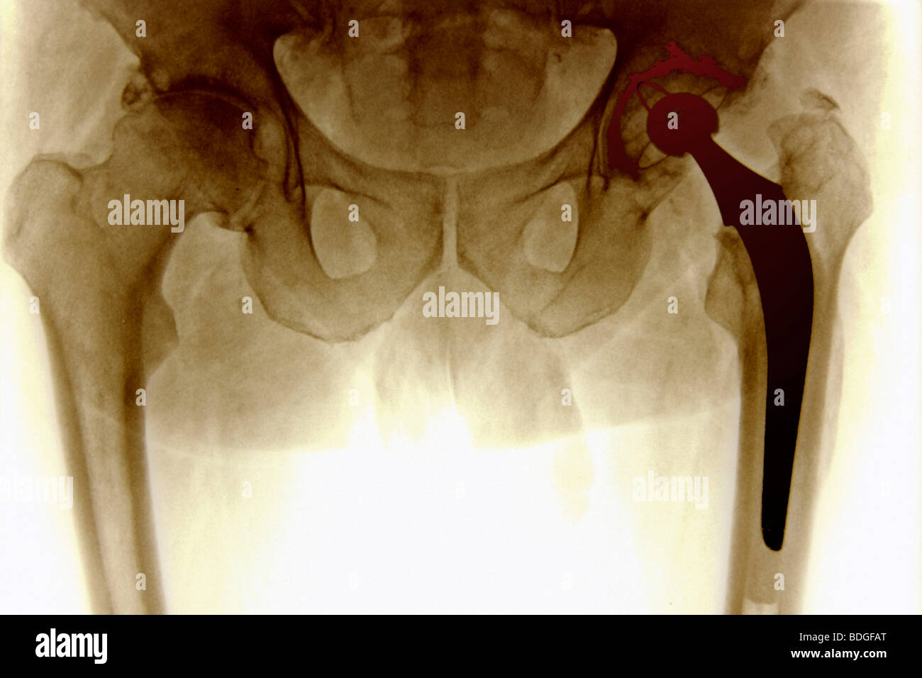 HIP PROSTHESIS, XRAY Stock Photo Alamy
