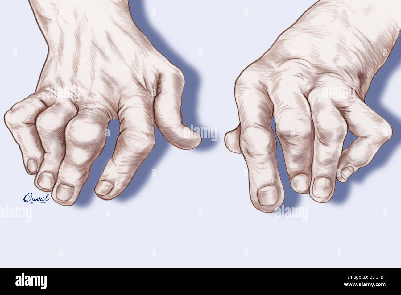 Rheumatoid Arthritis Hands Stock Photos \u0026 Rheumatoid