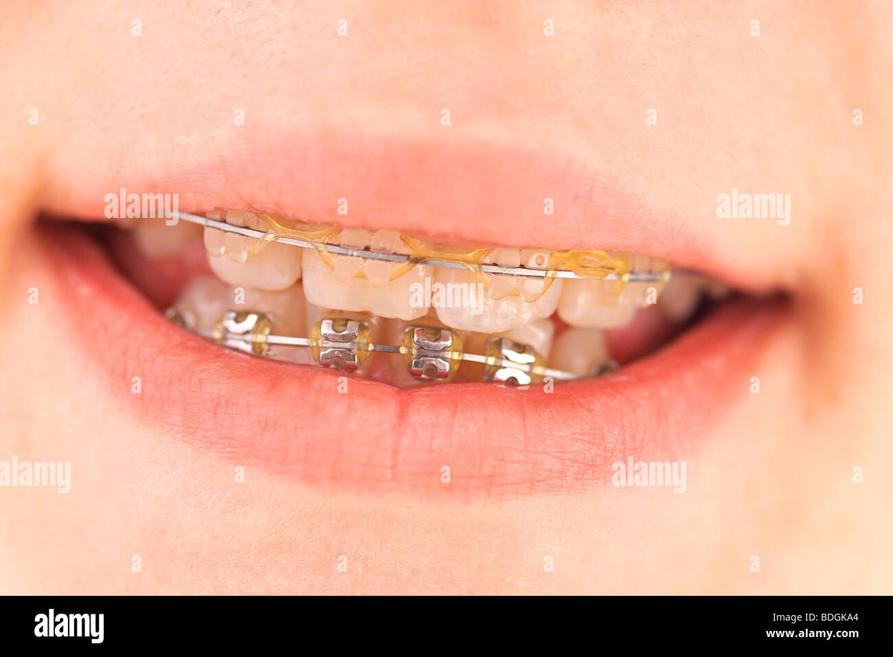 BRACE Stock Photo Alamy