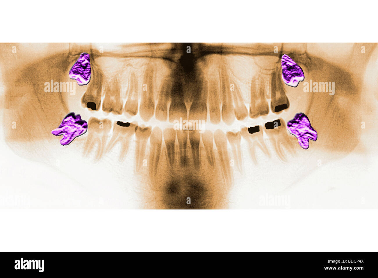 DENTAL XRAY RESULT Stock Photo Alamy