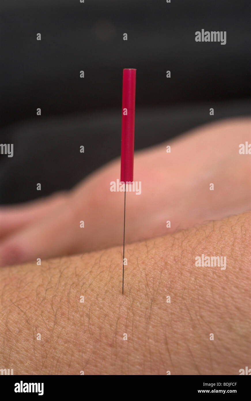 Acupuncture by the NHS Stock Photo Alamy