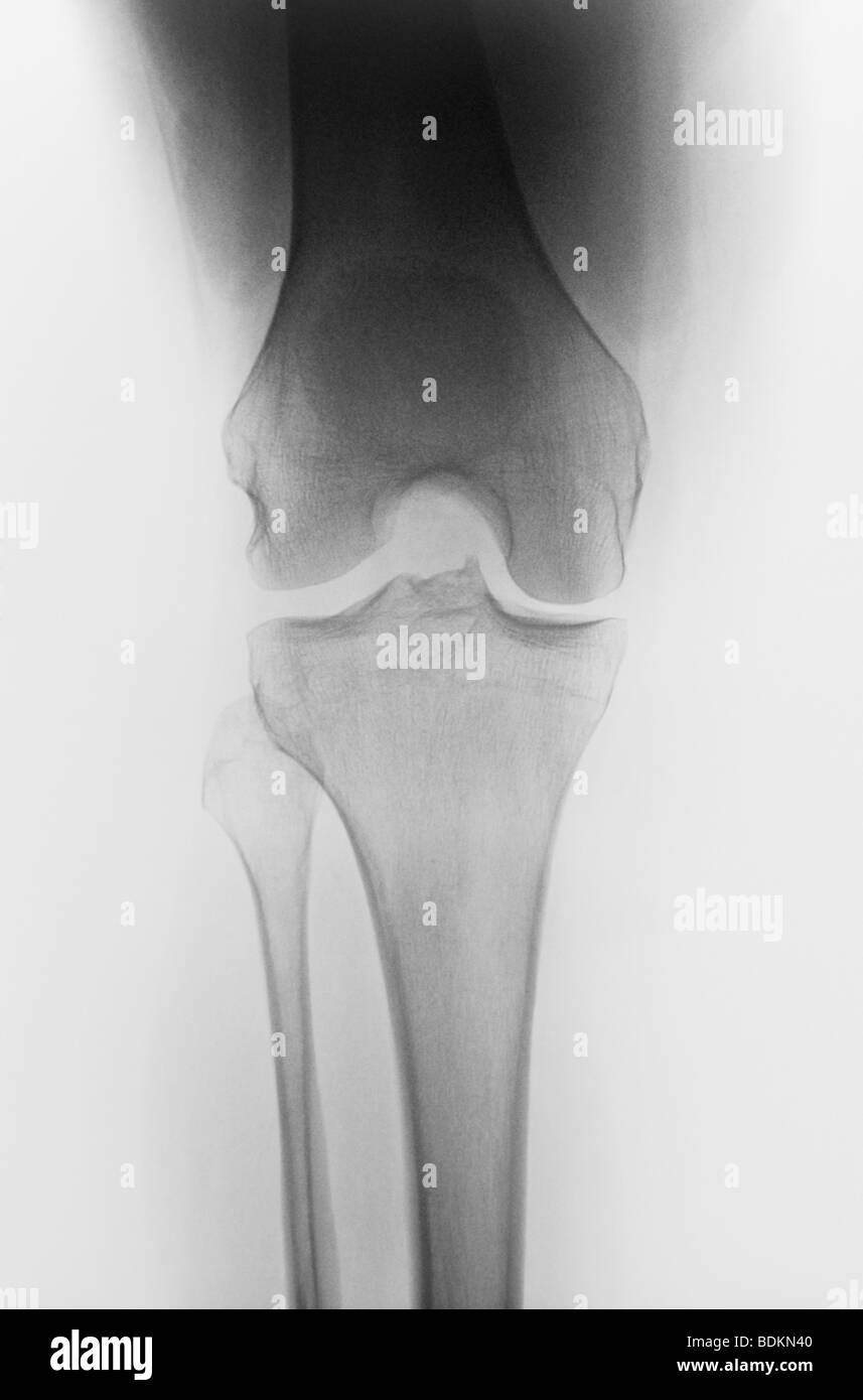 normal knee x-ray 32 year old female Stock Photo