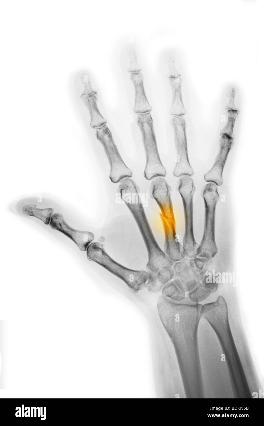 hand x-ray showing a fracture of the middle metacarpal Stock Photo