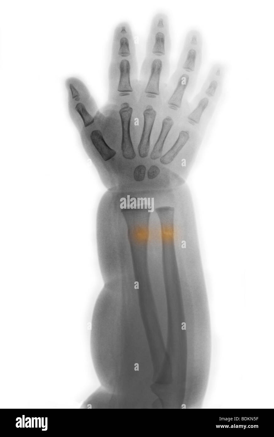 x-ray of the forearm of an infant showing a greenstick (buckle) fracture of the radius and ulna Stock Photo
